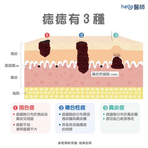 陰莖長痣|陰莖上的痣：該看皮膚科還是泌尿科？手術後恢復期大約多久？